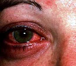 Xử trí khi bị đau mắt đỏ như thế nào để tránh biến chứng đáng tiếc